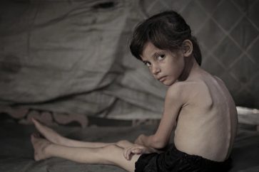 Lana Salih Juha, cinq ans, souffrant de malnutrition sévère, à Gaza. ©Anadolu